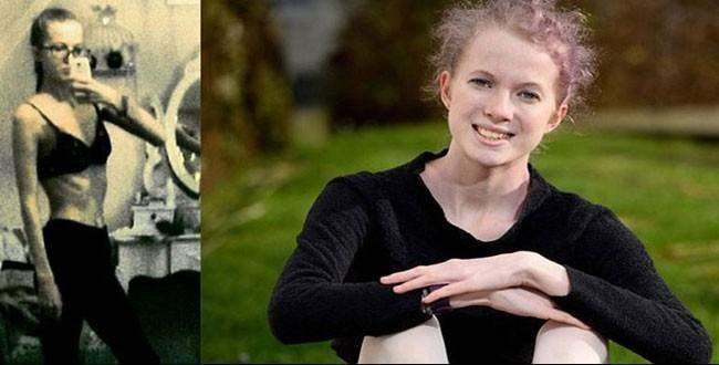 Günde 50 kaloriyle yaşıyordu ölümden döndü