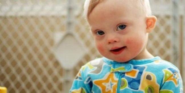 Down Sendromunun Belirtileri Nelerdir?