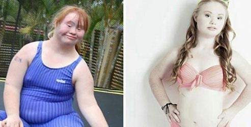 Down Sendromlu modelin hikayesi