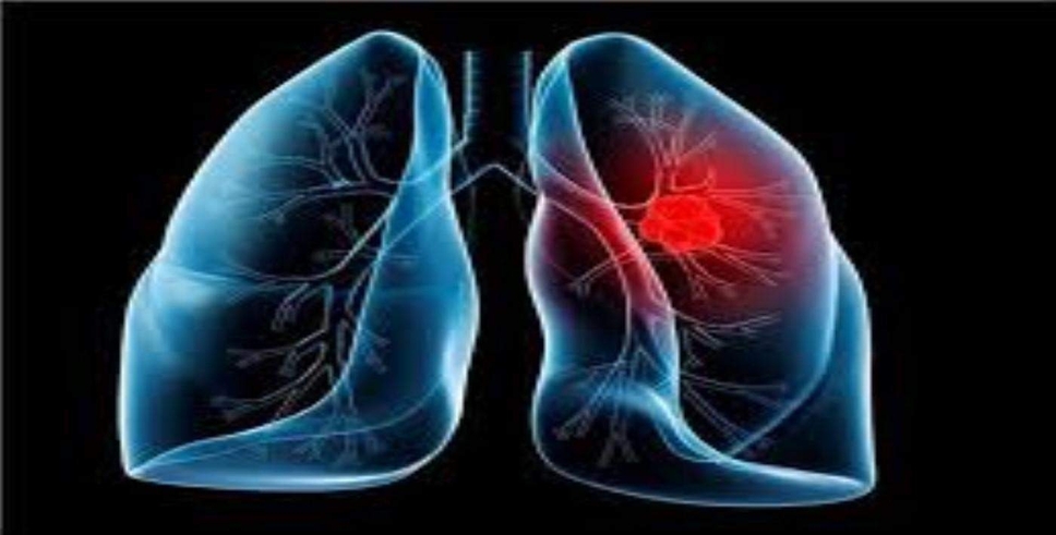 Sigaraya bağlı gizemli akciğer hastalığından ilk ölüm